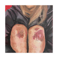"bruised knees" PRINT