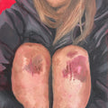 "bruised knees" ORIGINAL